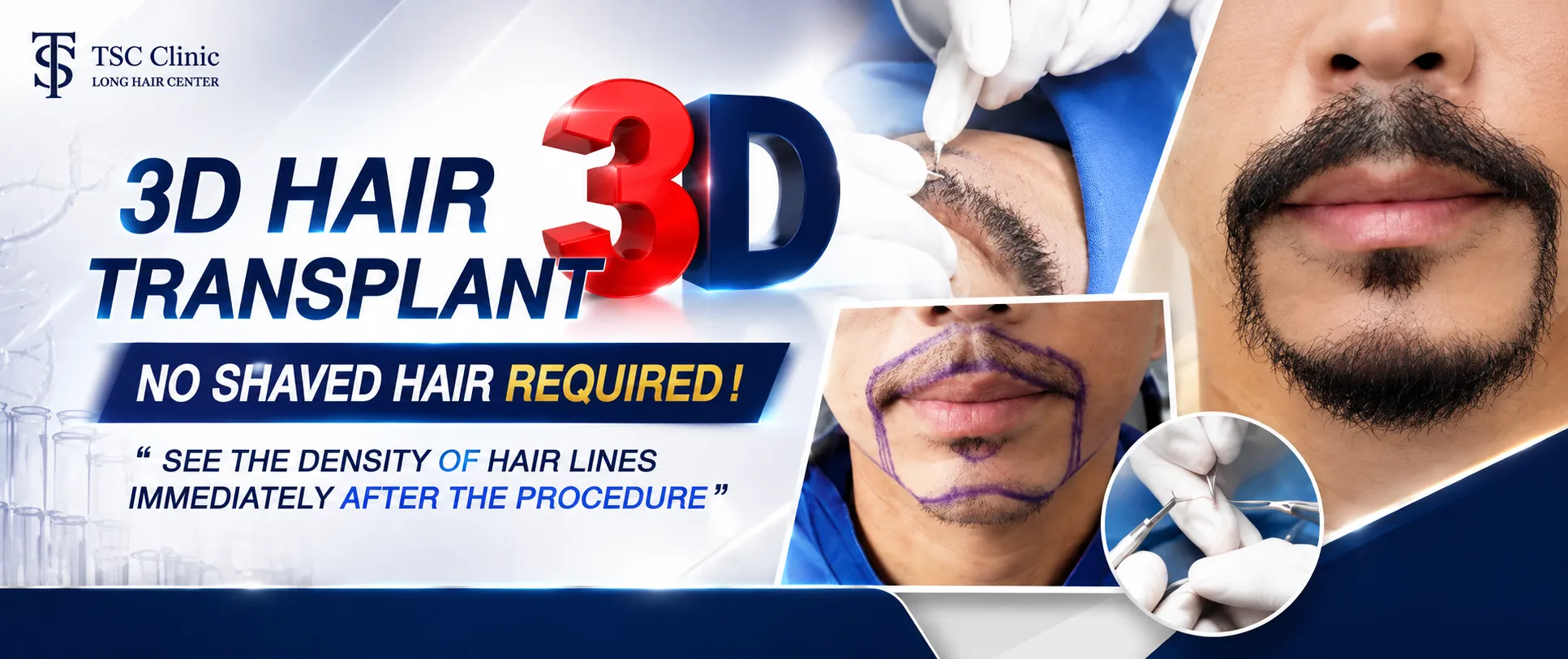 3D Beard & Sideburn Transplant with Long Hair FUI at Dr.Top Hair Hospital